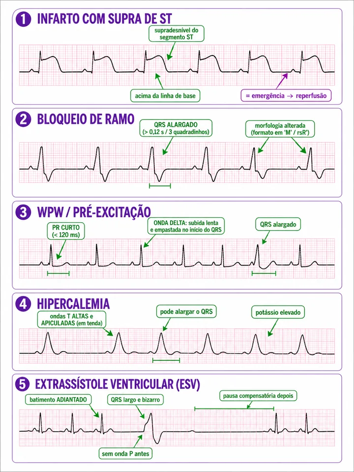 Página de traçados de ECG comentados